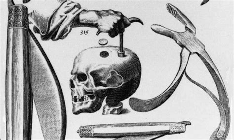 is trepanning still used today.